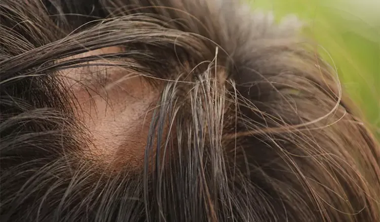 Castor oil 2025 on scalp
